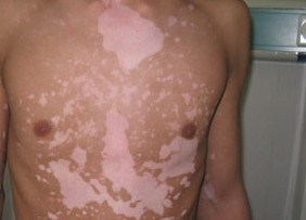 男性白癜风不及时治疗会导致哪些并发症 男性白癜风不及时治疗会导致哪些并发症