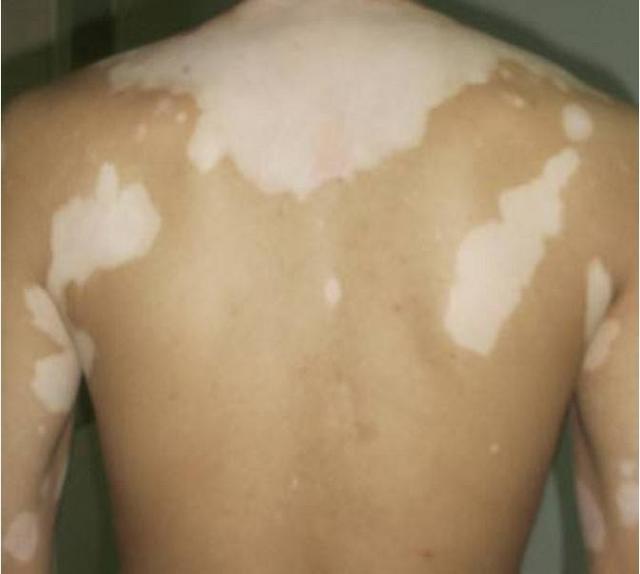 男性白癜风患者怎样护理才能避免复发 男性白癜风患者怎样护理才能避免复发