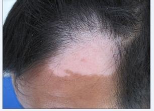 白癜风图片 白癜风图片