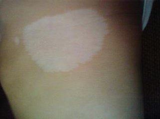 白癜风图片 白癜风图片