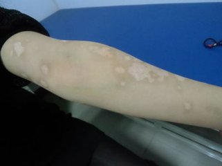 白癜风图片 白癜风图片