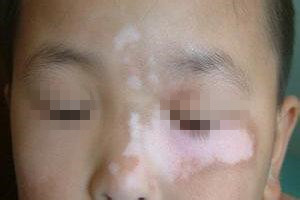 白癜风常见的治疗方法有哪些