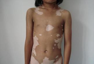 白癜风图片 白癜风图片