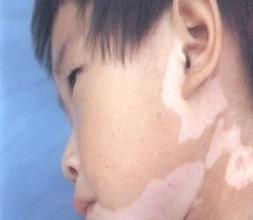 白癜风图片 白癜风图片