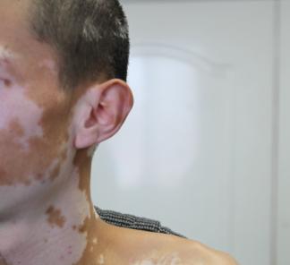 老年白癜风的治疗应该注意哪些方面