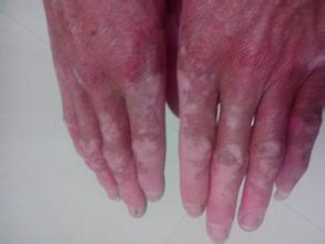 白癜风图片 白癜风图片