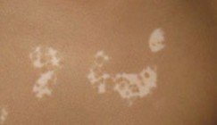 白癜风图片 白癜风图片