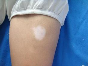 白癜风图片 白癜风图片