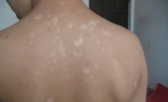 哪些症状说明男性白癜风病情在好转 哪些症状说明男性白癜风病情在好转