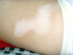 白癜风图片 白癜风图片