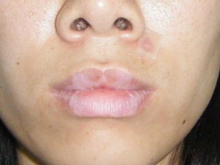 白癜风图片 白癜风图片