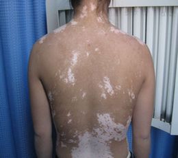  男性白癜风的潜在危害有哪些