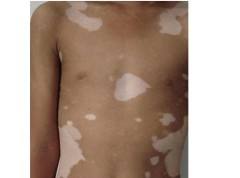 节段型白癜风的具体治疗方法有哪些