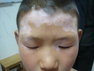 白癜风图片 白癜风图片