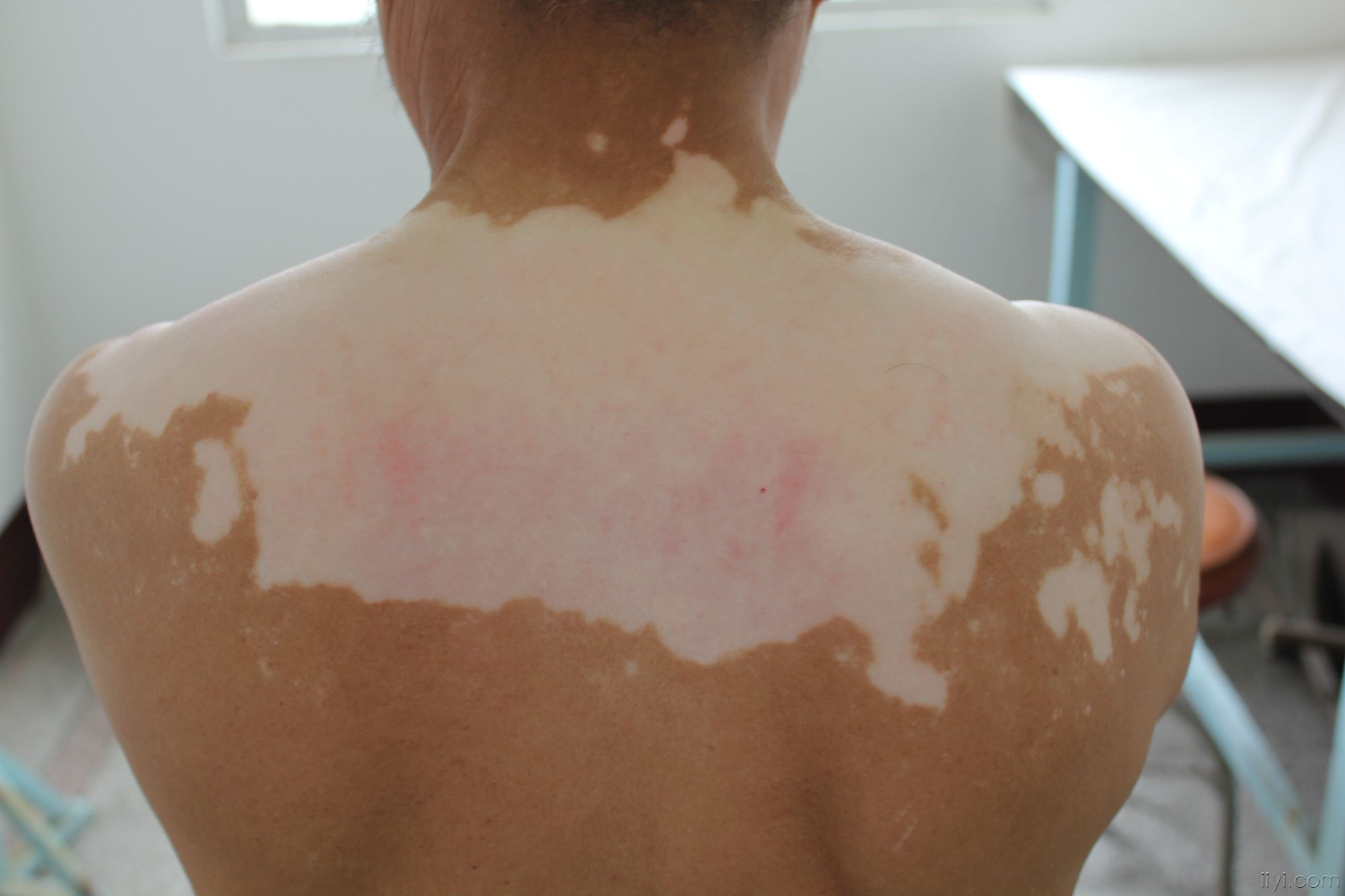 治疗白癜风大概多久见效