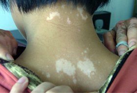 白癜风图片 白癜风图片