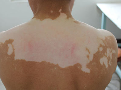 男人白癜风患者怎么预防白癜风 男人白癜风患者怎么预防白癜风